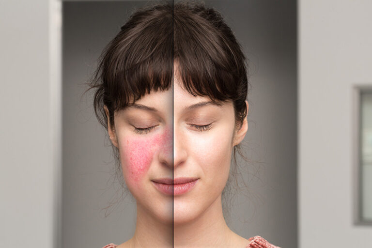 Przebarwienia skóry: Jak dermatolog może Ci pomóc?